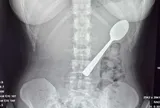 Đang ăn sữa chua, người phụ nữ nuốt chiếc thìa dài 17cm vào bụng