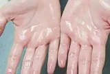 Cách kiểm soát tình trạng ra mồ hôi tay hiệu quả bậc nhất