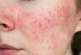Thử thách "nguy hiểm cho da" để tự chữa lành gây tranh cãi