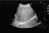 Nam sinh 15 tuổi "gan trắng xoá", bác sĩ chỉ thẳng do 2 món khoái khẩu "vạn người mê”