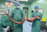 Người đàn ông 4 tháng không đi đại tiện, bụng phình to như "mang thai", bác sĩ lấy ra thứ "đáng sợ"