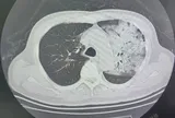 Người đàn ông 70 tuổi, tưởng cảm cúm hóa ra phổi “trắng xóa”: Biết "thủ phạm" nhiều người hoang mang
