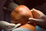 Mang "quả tạ" gần 4kg suốt nhiều năm, người phụ nữ bàng hoàng khi biết sự thật