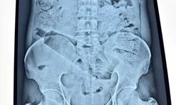 Người đàn ông đau bụng 36 tiếng, bác sĩ phát hiện "bí mật" bên trong