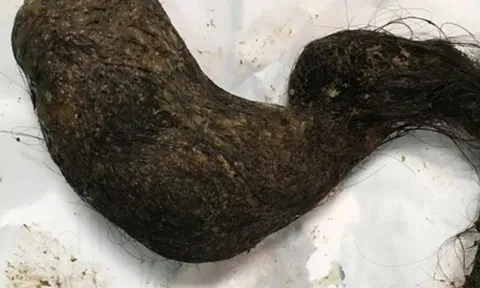 Bé trai bụng cứng như đá, bác sĩ choáng khi phát hiện "bí mật" bên trong