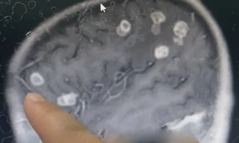 Bé gái sốt liên tục 17 ngày, bác sĩ sốc nặng khi phát hiện "bí mật" đáng sợ