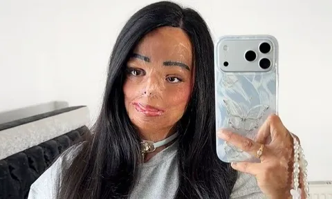 Dầu gội đầu bắt lửa, cô gái xinh đẹp bị bỏng nửa người và cái kết bất ngờ