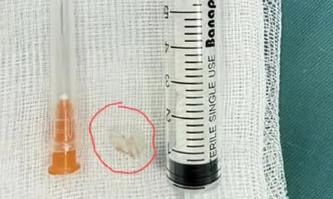 Bé trai 7 tuổi xẹp phổi trái, bác sĩ gắp ra thứ "đáng sợ" bên trong