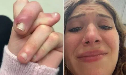 Người phụ nữ 21 tuổi suýt mất ngón vì thói quen "vạn người mê"