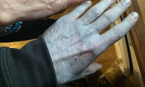 Toàn thân tím tái, người đàn ông vội đến bệnh viện và cái kết