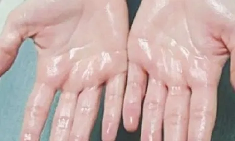 Cách kiểm soát tình trạng ra mồ hôi tay hiệu quả bậc nhất