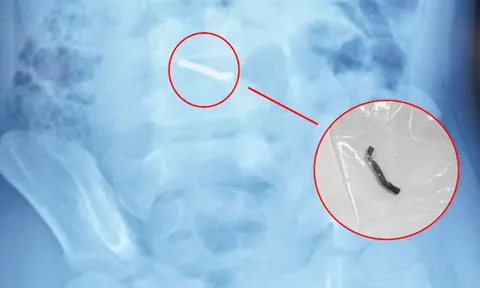 Bé trai 5 tuổi nuốt hàng chục viên nam châm gây thủng ruột