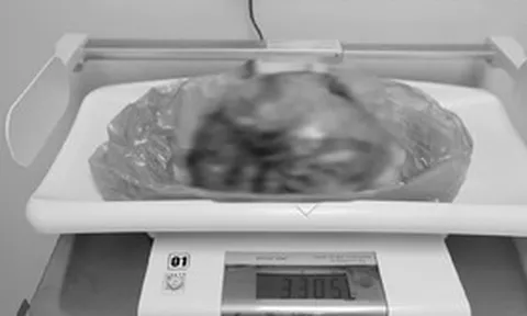 Phát hiện "thứ đáng sợ" nặng hơn 3kg trong bụng người phụ nữ 42 tuổi