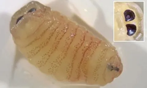 Người phụ nữ 58 tuổi “sốc nặng” khi hắt hơi ra hàng loạt con giòi sống từ trong mũi