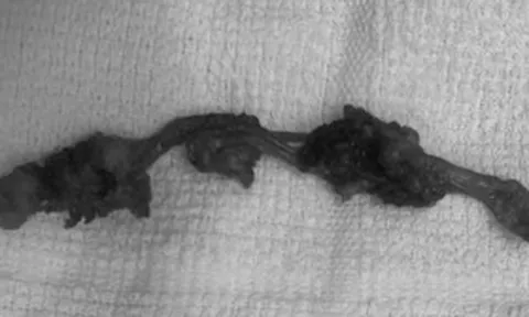 Đau âm ỉ vùng bụng, người đàn ông sốc nặng khi bác sĩ lấy ra thứ "rợn người" trong cơ thể