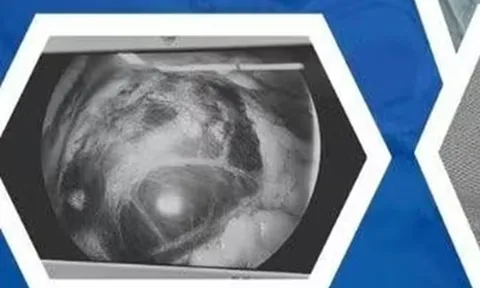 Chỉ đau bụng nhẹ nên chủ quan, người phụ nữ "chết lặng" khi phát hiện thai lạc chỗ ở vị trí cực kỳ nguy hiểm