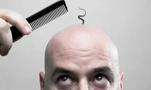 Hé lộ quốc gia có tỉ lệ đàn ông hói đầu cao nhất thế giới, vị trí số 1 gây bất ngờ
