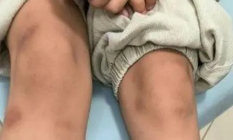 Ăn thịt nướng cuốn xà lách, bé trai 6 tuổi nổi đầy vết bầm tím "bất thường"