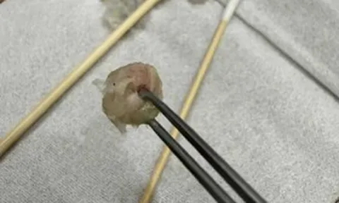 Bé gái 6 tuổi nhập viện khẩn cấp, bố mẹ "sốc" khi bác sĩ lấy ra thứ "đáng sợ" từ mũi con
