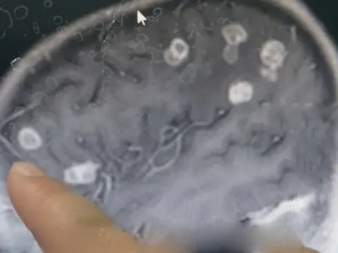 Bé gái sốt liên tục 17 ngày, bác sĩ sốc nặng khi phát hiện "bí mật" đáng sợ