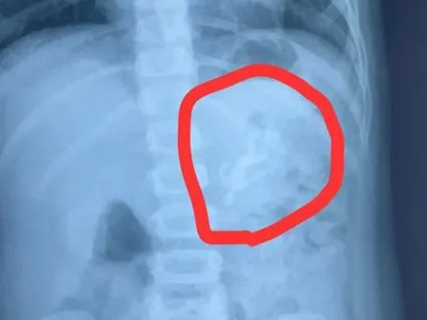 Bé trai liên tục nôn mửa, bác sĩ sốc nặng khi thấy thứ bên trong bụng