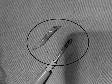 Người đàn ông 41 tuổi đau bụng, bác sĩ sốc phát hiện ra thứ đáng sợ "đi lạc" trong bụng