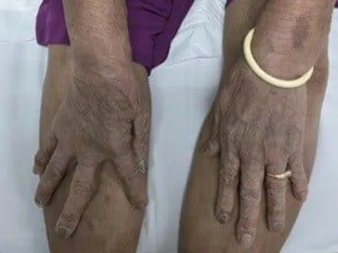 Tin vào thuốc lạ “uống thấy khỏe”, cụ ông 87 tuổi nhập viện trong tình trạng nguy kịch