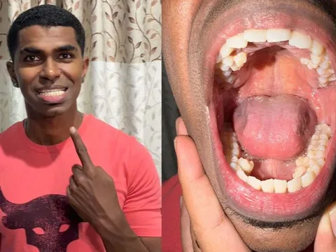 Tưởng mọc răng “bất thường”, chàng trai đi khám và phát hiện mình nắm kỷ lục hiếm có