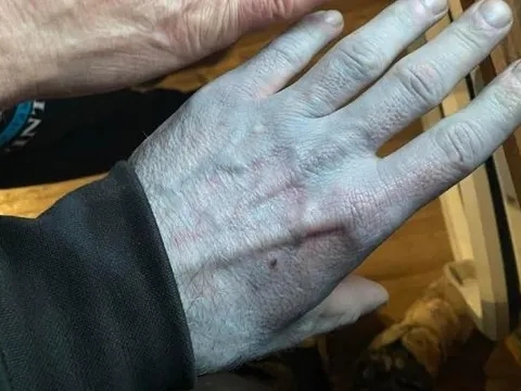 Toàn thân tím tái, người đàn ông vội đến bệnh viện và cái kết