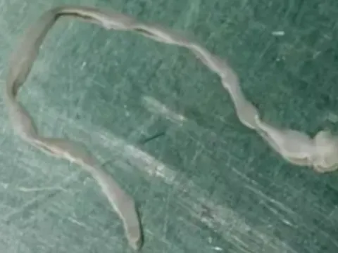 Người phụ nữ lên cơn co giật, bác sĩ lấy ra thứ đáng sợ trong não