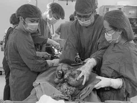 Đau âm ỉ vùng bụng suốt, người phụ nữ sốc khi bác sĩ lấy ra thứ "đáng sợ" trong cơ thể mình