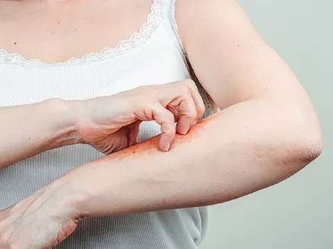 Luôn cảm thấy ngứa, người phụ nữ 59 tuổi "sốc" khi biết mình mắc liền 2 căn bệnh nguy hiểm này